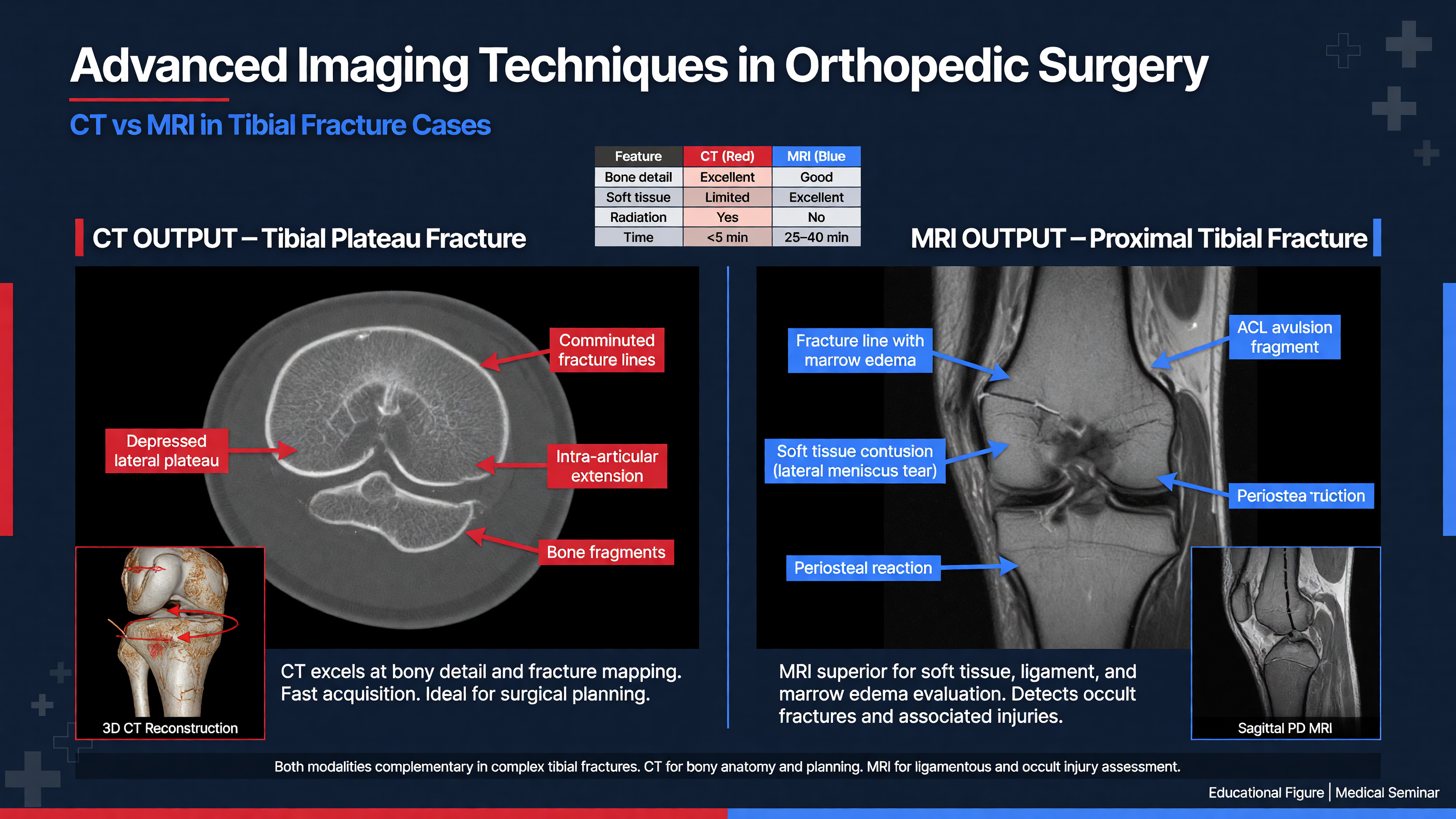 Example of CT and MRI outputs in tibial fracture cases